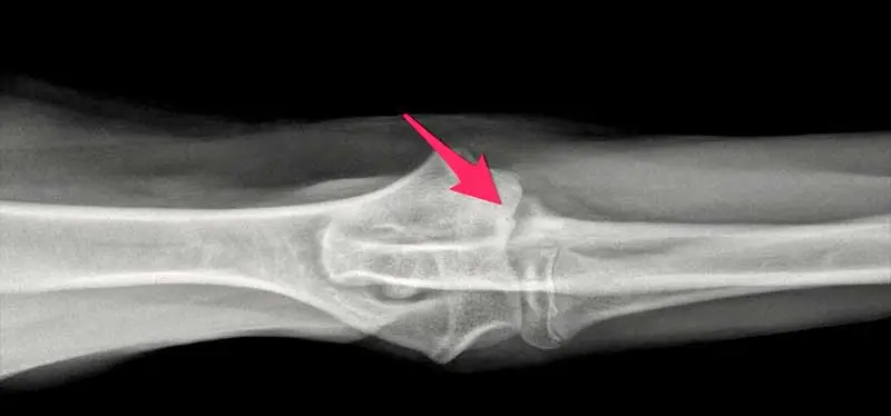 Elbow Osteochondritis Dissecans (OCD) — elbow OCD diagnostic imaging context at RehabVet Singapore