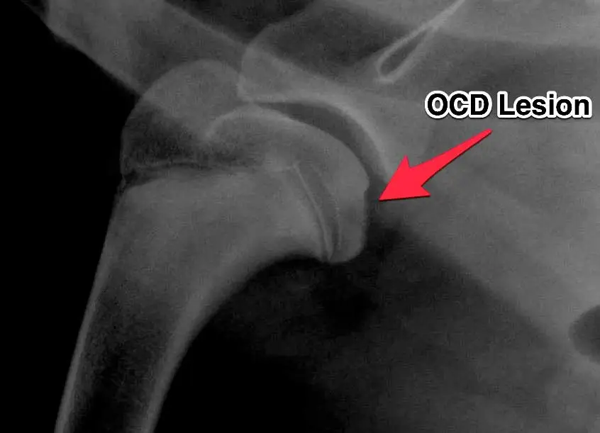 Shoulder Osteochondritis Dissecans (OCD) — shoulder OCD diagnostic imaging context at RehabVet Singapore